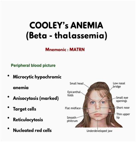 Beta Thalassemia (Cooley's Anemia).
